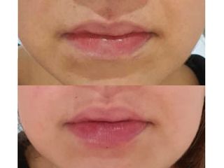 Antes y después de Aumento de labios, con Ácido Hialurónico