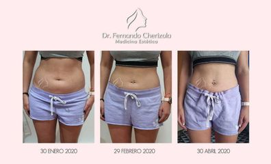 Antes y después de Cavitación 