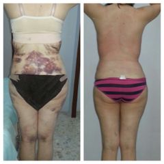 Antes y después de Liposucción 