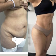 LipoKinni 360