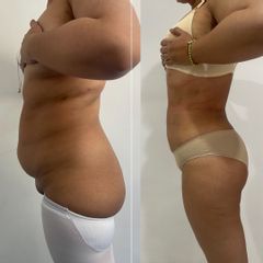 Lipokinni