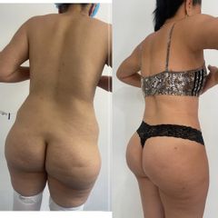 LipoKinni