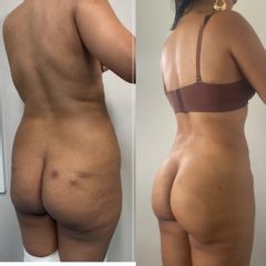 LipoKInni