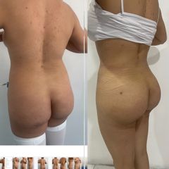 LipoKinni