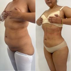 Lipokinni
