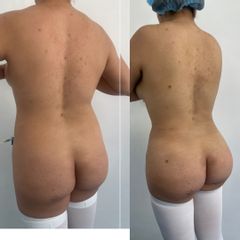 LipoKinni
