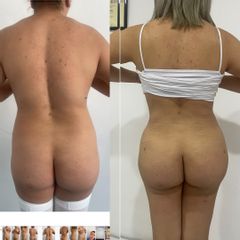 LipoKinni