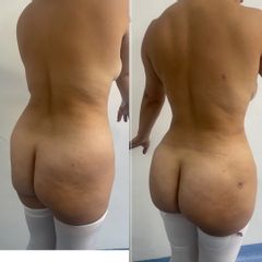 Lipokinni