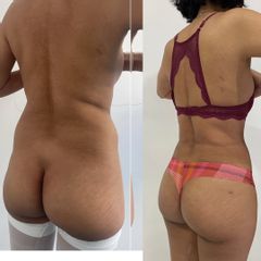 Lipokinni
