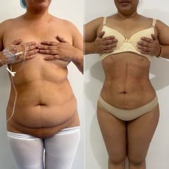 LipoKinni
