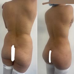Lipokinni