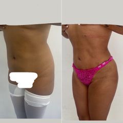 LipoKinni