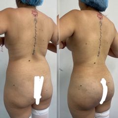 LipoKinni