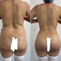 LipoKinni