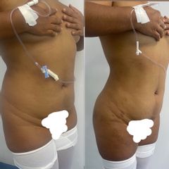 LipoKinni