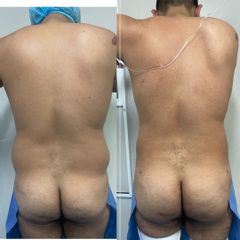 lipokinni man