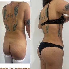 LipoKinni - Dr. José Miguel De la Fuente Coutiño