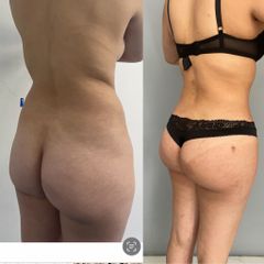LipoKinni - Dr. José Miguel De la Fuente Coutiño