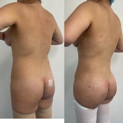 LipoKinni - Dr. José Miguel De la Fuente Coutiño
