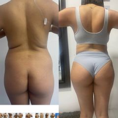 LipoKinni - Dr. José Miguel De la Fuente Coutiño