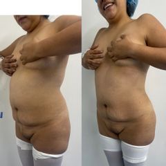 LipoKinni - Dr. José Miguel De la Fuente Coutiño