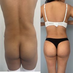 LipoKinni - Dr. José Miguel De la Fuente Coutiño