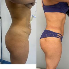 LipoKinni - Dr. José Miguel De la Fuente Coutiño