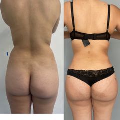 LipoKinni - Dr. José Miguel De la Fuente Coutiño