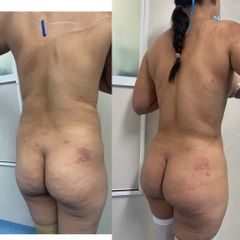 LipoKinni - Dr. José Miguel De la Fuente Coutiño