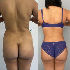 LipoKinni - Dr. José Miguel De la Fuente Coutiño