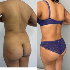LipoKinni - Dr. José Miguel De la Fuente Coutiño