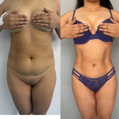 LipoKinni - Dr. José Miguel De la Fuente Coutiño
