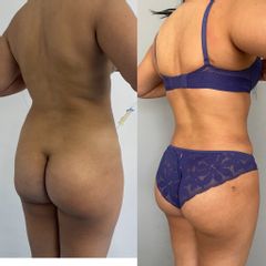 LipoKinni - Dr. José Miguel De la Fuente Coutiño