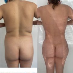 LipoKinni - Dr. José Miguel De la Fuente Coutiño