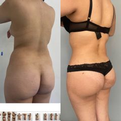 LipoKinni - Dr. José Miguel De la Fuente Coutiño