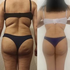LipoKinni - Dr. José Miguel De la Fuente Coutiño