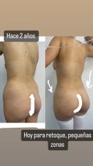 LipoKinni - Dr. José Miguel De la Fuente Coutiño