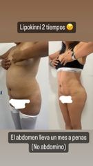 LipoKinni - Dr. José Miguel De la Fuente Coutiño