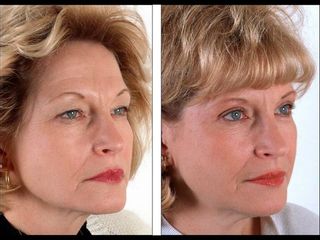 Antes y después de Rejuvenecimiento facial