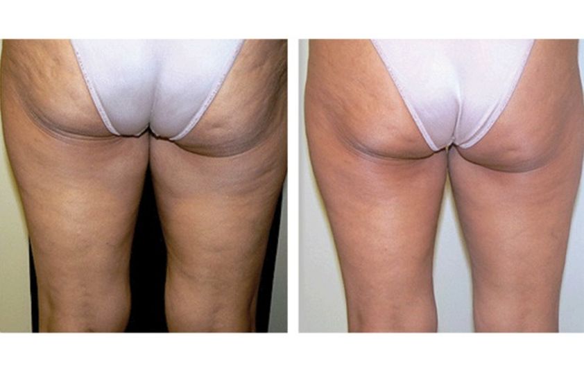 Carboxiterapia antes y después - 498021