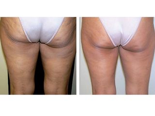 Antes y después de Carboxiterapia