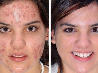Antes y después de tratamiento para eliminar acné.