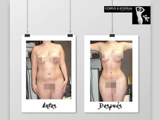 Antes y después de Liposucción