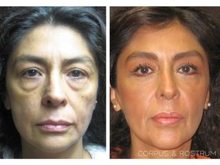 Antes y después de Blefaroplastia