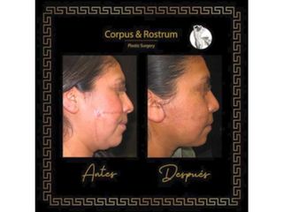 Antes y después de Cirugía para cicatrices