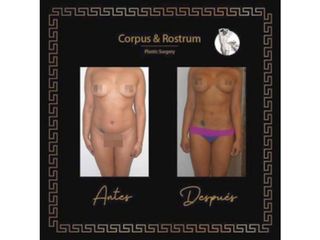 Antes y después de Liposucción
