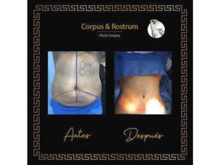 Antes y después de Liposucción