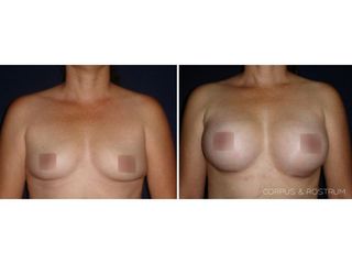 Antes y después de Aumento de busto