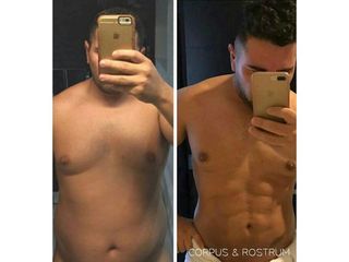 Antes y después de Lipoescultura HD