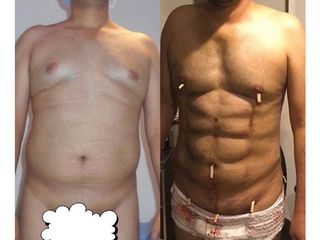 Antes y después de Liposucción HD